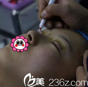 双眼皮术前画线 双眼皮术前画线