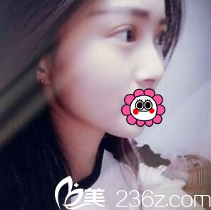 术后半个月恢复照 术后半个月恢复照