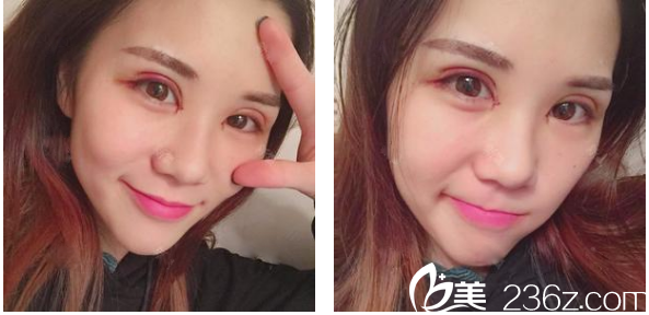 深圳<!--<i data=20240703-sp></i>-->整形科贾维顺双眼皮术后七天图片 深圳<!--<i data=20240703-sp></i>-->整形科贾维顺双眼皮术后七天图片