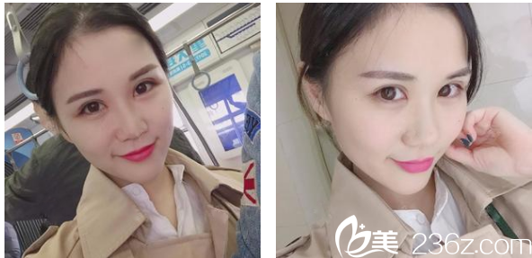 找深圳<!--<i data=20240703-sp></i>-->整形科贾维顺做完双眼皮两周图片 找深圳<!--<i data=20240703-sp></i>-->整形科贾维顺做完双眼皮两周图片