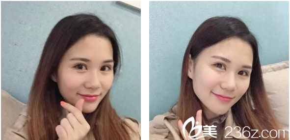看看我去深圳博爱医院做完双眼皮一个月的效果图片