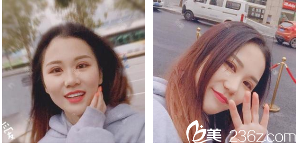 不知不觉找深圳<!--<i data=20240703-sp></i>-->贾维顺做完切开双眼皮四十天了 不知不觉找深圳<!--<i data=20240703-sp></i>-->贾维顺做完切开双眼皮四十天了