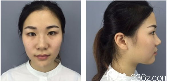 来深圳博爱割双眼皮前的照片 来深圳博爱割双眼皮前的照片