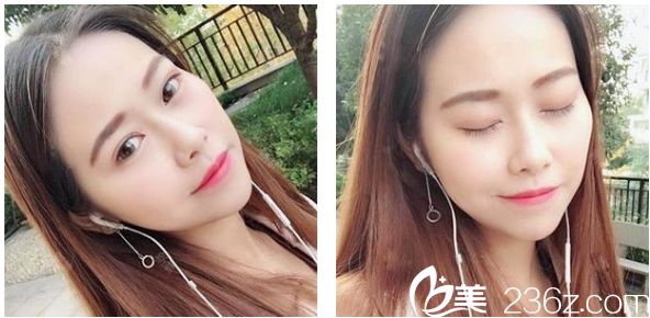 去深圳博爱整形医院做完鼻综合隆鼻术后一个月生活照 去深圳博爱整形医院做完鼻综合隆鼻术后一个月生活照