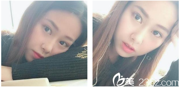 找深圳博爱整形医院贾维顺做鼻综合术后两周恢复效果图 找深圳博爱整形医院贾维顺做鼻综合术后两周恢复效果图