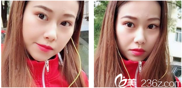 深圳博爱整形医院贾维顺鼻综合隆鼻术后九天图片 深圳博爱整形医院贾维顺鼻综合隆鼻术后九天图片