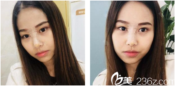 去深圳博爱整形医院做完假体和耳软骨隆鼻五天图片 去深圳博爱整形医院做完假体和耳软骨隆鼻五天图片