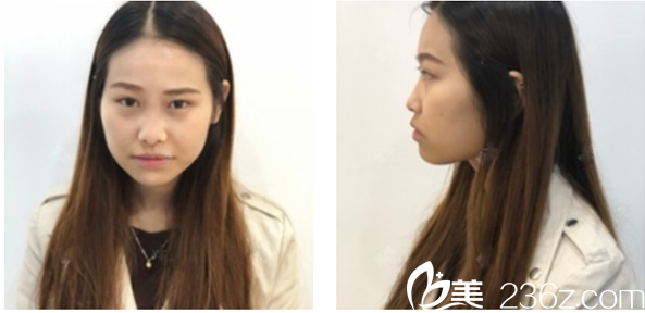 术前塌鼻梁图片 术前塌鼻梁图片