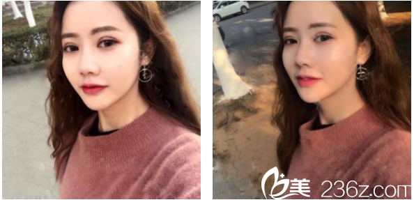 广州壹加壹整形医院项美莲双眼皮术后两周恢复效果图 广州壹加壹整形医院项美莲双眼皮术后两周恢复效果图