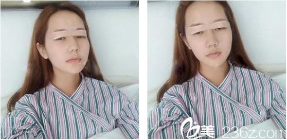 来找广州壹加壹整形医院做完双眼皮第二天图片 来找广州壹加壹整形医院做完双眼皮第二天图片