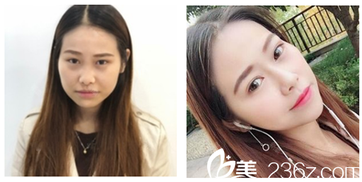 广州壹加壹项美莲双眼皮<span style=