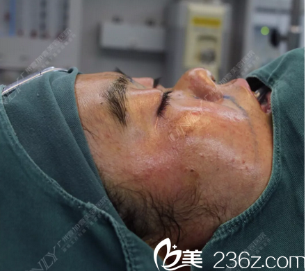 李明主任肋软骨综合隆鼻术前麻醉