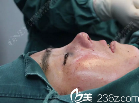 广州壹加壹李明主任肋软骨鼻综合隆鼻术后即刻效果图