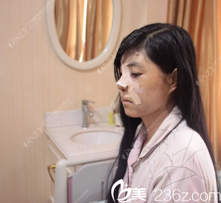 广州壹加壹李明主任肋软骨鼻综合隆鼻术后第三天图片