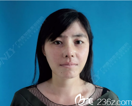 广州壹加壹李明主任隆鼻术后十天拆线正面图片