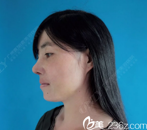 看看广州壹加壹李明肋软骨鼻隆鼻术后十天侧面图片