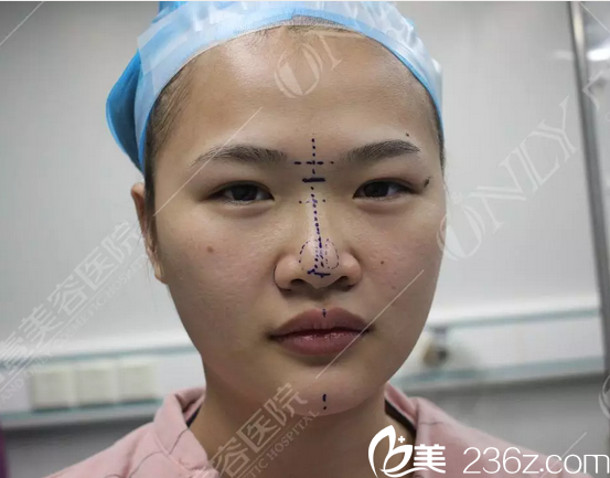 隆鼻术前正面照片来一张 隆鼻术前正面照片来一张