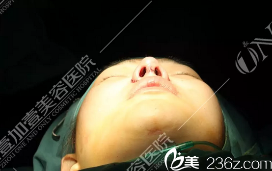 广州壹加壹整形医院李明隆鼻术后即刻效果图 广州壹加壹整形医院李明隆鼻术后即刻效果图