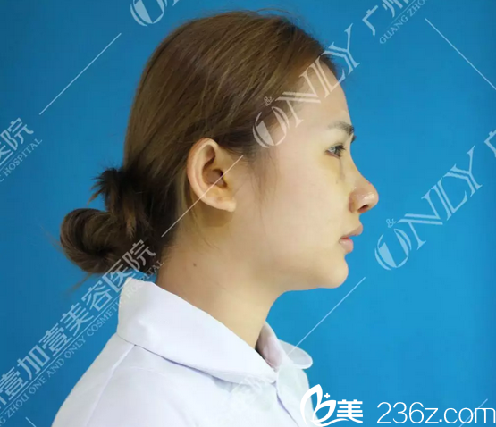 找广州壹加壹李明主任做完隆鼻术后第三天图片 找广州壹加壹李明主任做完隆鼻术后第三天图片