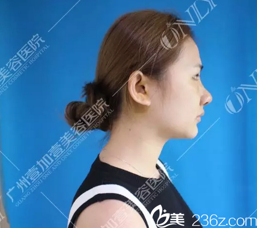 找广州壹加壹李明主任做完隆鼻术后七天恢复情况 找广州壹加壹李明主任做完隆鼻术后七天恢复情况