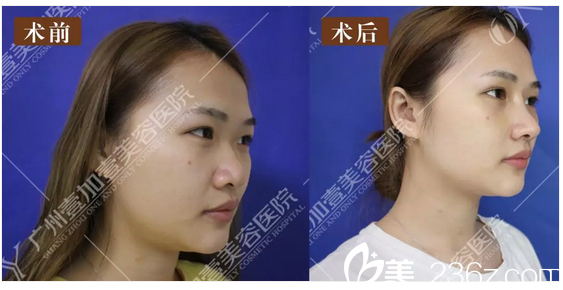 广州壹加壹李明主任隆鼻案例对比图 广州壹加壹李明主任隆鼻案例对比图