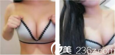 自从去了上海鸥美药妆找宣庆元做自体脂肪隆胸，和之前的小胸说拜拜