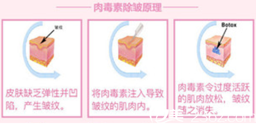 注射除皱一般多少钱？长春子田瘦脸除皱注射除皱1280元/部位帮你解决皱纹