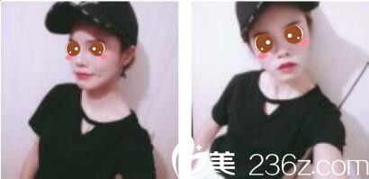 我在上海鸥美药妆找宣庆元做了假体隆鼻，术后两个月鼻子就看上去特别的挺
