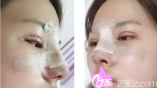 全切双眼皮+硅胶假体隆鼻术后当天