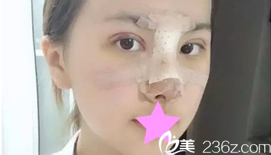 切开双眼皮和隆鼻第七天拆线前