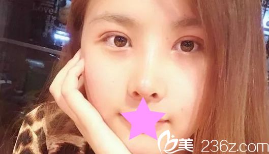 兰州韩美全切双眼皮+隆鼻半个月效果
