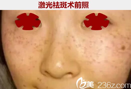 在厦门舒友千慕整形医院做祛斑术前照 在厦门舒友千慕整形医院做祛斑术前照