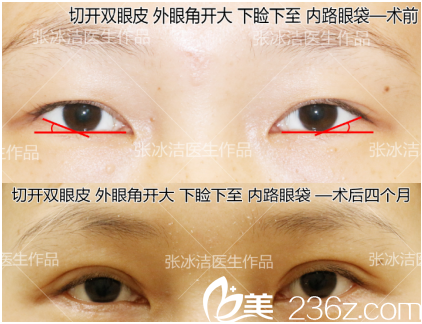 北京克莱美舍张冰洁医疗美容诊所切开双眼皮和外眼角开大及下睑下垂矫正案例