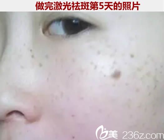 做完次激光祛斑治疗5天后的照片 做完次激光祛斑治疗5天后的照片