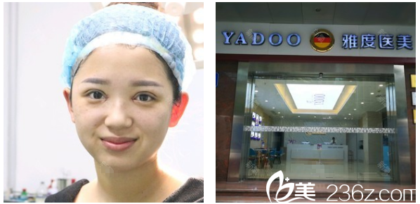 广州雅度医学美容医院切开双眼皮术后即刻效果图