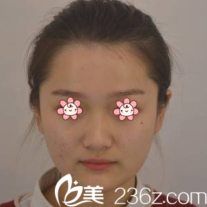 打算去重庆光博士整形前的我 打算去重庆光博士整形前的我