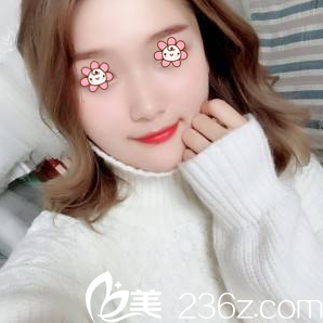 才俊明下颌角整形术后18天 才俊明下颌角整形术后18天