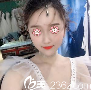 重庆光博士整形下颌角手术33天 重庆光博士整形下颌角手术33天