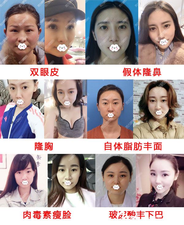 随州奥莱整形真人案例效果对比