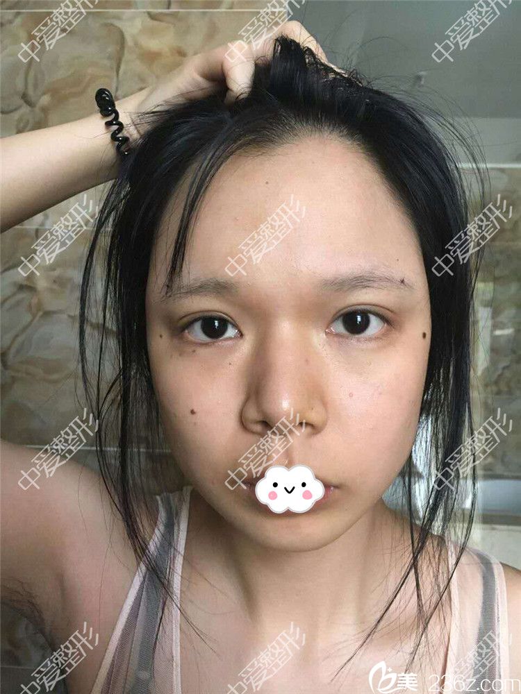 随州奥莱<!--<i data=20240703-sp></i>-->自体脂肪丰面案例 随州奥莱<!--<i data=20240703-sp></i>-->自体脂肪丰面案例