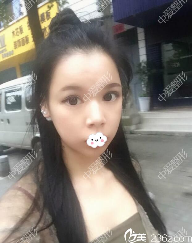 随州奥莱<!--<i data=20240703-sp></i>-->自体脂肪面部填充真人案例 随州奥莱<!--<i data=20240703-sp></i>-->自体脂肪面部填充真人案例