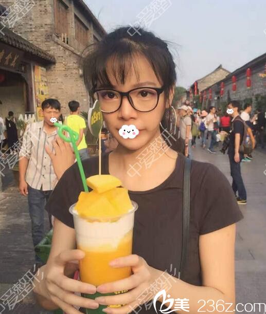 随州奥莱<!--<i data=20240703-sp></i>-->自体脂肪填充太阳穴效果 随州奥莱<!--<i data=20240703-sp></i>-->自体脂肪填充太阳穴效果