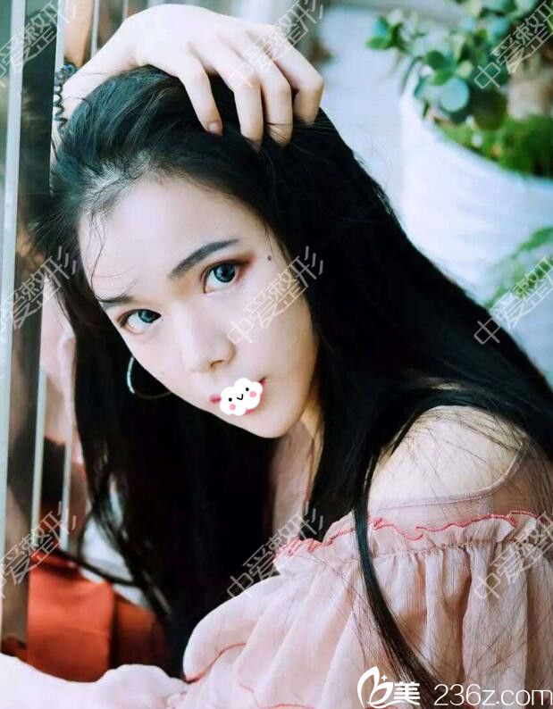 随州奥莱自体脂肪丰面效果怎么样 随州奥莱自体脂肪丰面效果怎么样