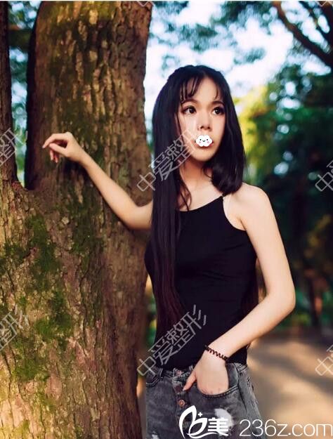 随州奥莱院长自体脂肪填充太阳穴+额头效果怎么样？看我真人案例