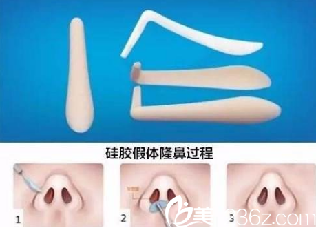 长春隆鼻手术哪好？长春卓研假体隆鼻8900元就能让你拥有小翘鼻