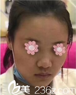 在雅美做鼻综合术前照 在雅美做鼻综合术前照