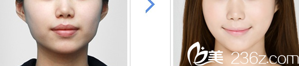 韩国SoonPlus整形外科医院面部轮廓整形案例