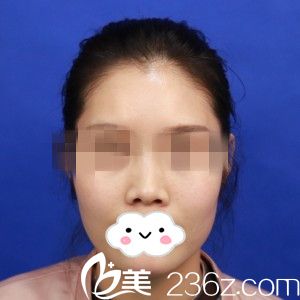 手术前的我 手术前的我