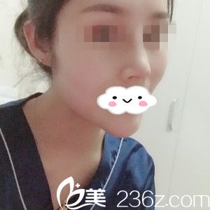 术后半个月 术后半个月