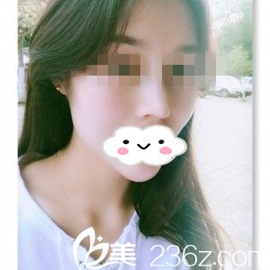 分享我在株洲华美年华做假体隆鼻+垫下巴一个多月的恢复过程